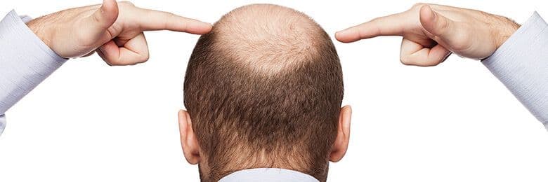 360 Vertex Hair Transplantation